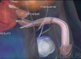 Prostat Alımı Prostat Alımı