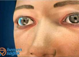 Presbiyopiye Giriş Presbiyopiye Giriş